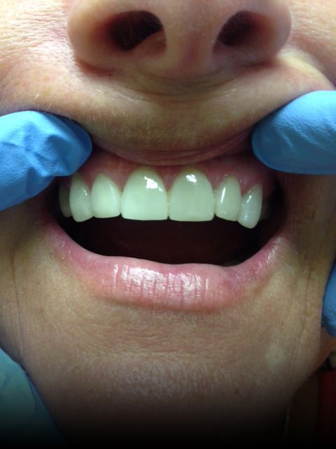 image of after porcelain veneers
