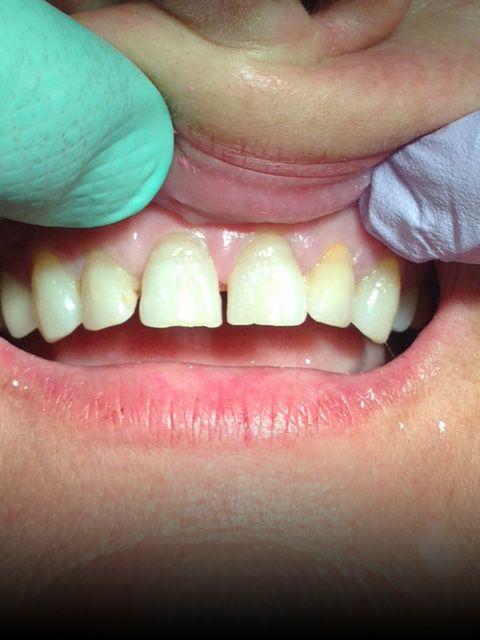 image of before porcelain veneers