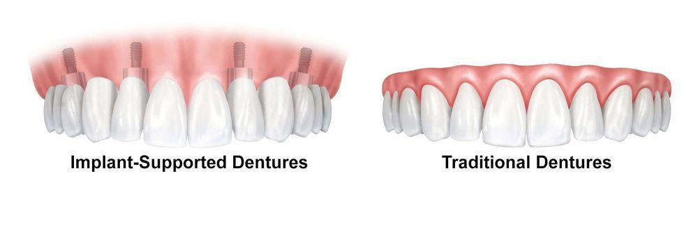Implant-supported vs. traditional dentures